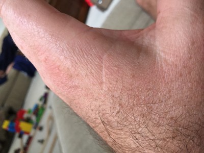 Three Stiches
