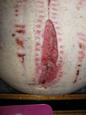 SurgeryScar2018.JPG