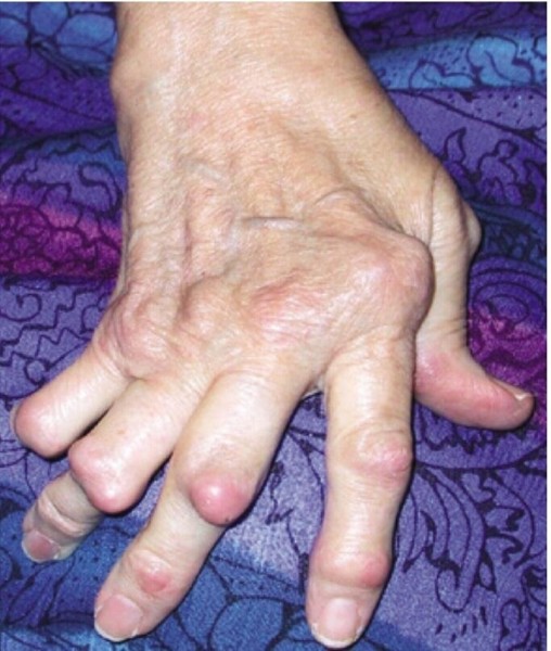 7f0bb8be083ab9af3871ff90f36e85b0--rheumatoid-nodules-joint.jpg
