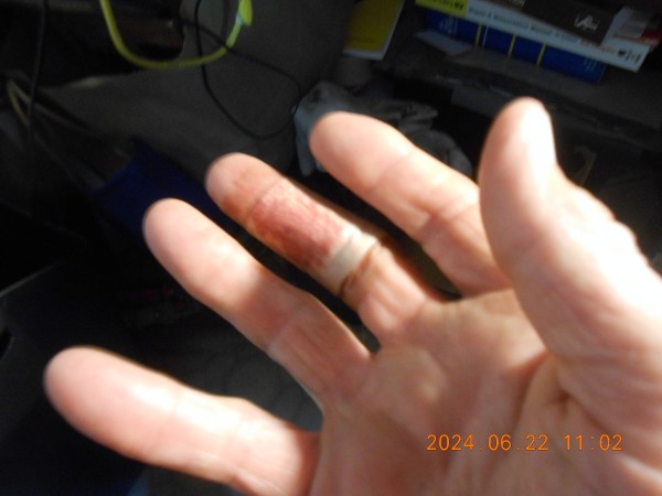 A small puncture wound. Miss Joy said I left a good blood trail all the way to the bathroom sink.