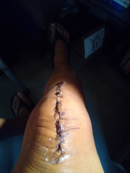 1000000446.jpg (84.84 KiB) Viewed 8406 times Bandage removed by nurse yesterday.