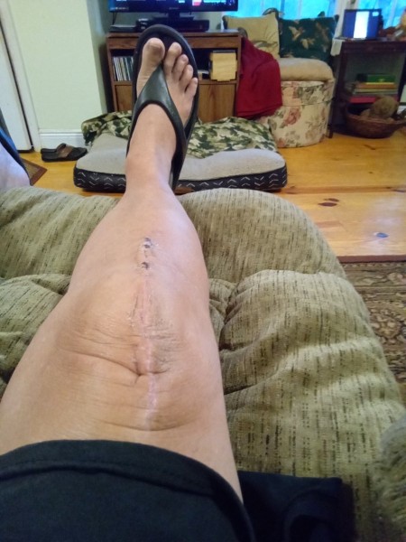 1000000475.jpg (158.9 KiB) Viewed 11686 times 3 small scabs remaining