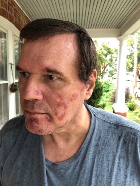 Chris shingles August 2019a re.jpg